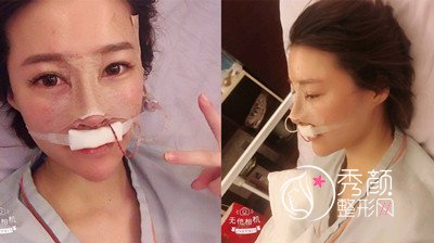 上海艺星许炎龙（肋软骨+膨体）鼻部手术案例分享