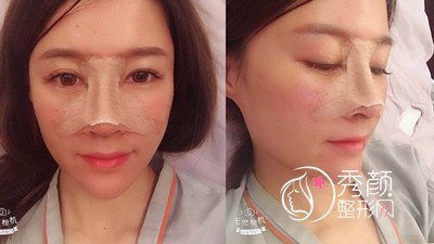 上海艺星许炎龙(肋软骨+膨体)鼻部手术案例分享