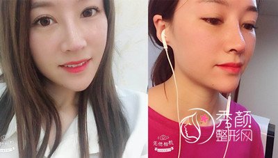 上海艺星许炎龙(肋软骨+膨体)鼻部手术案例分享