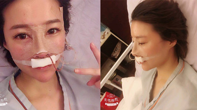 上海艺星许炎龙（肋软骨+膨体）鼻部手术案例分享