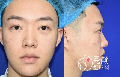 上海男士肋软骨隆鼻案例,恢复好了也是大帅哥一枚!