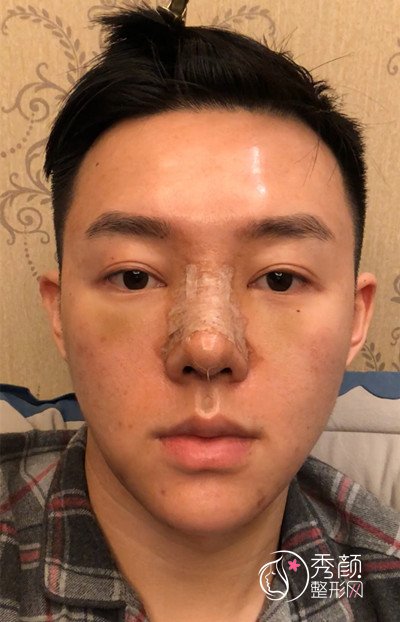 上海男士肋软骨隆鼻案例，恢复好了也是大帅哥一枚！