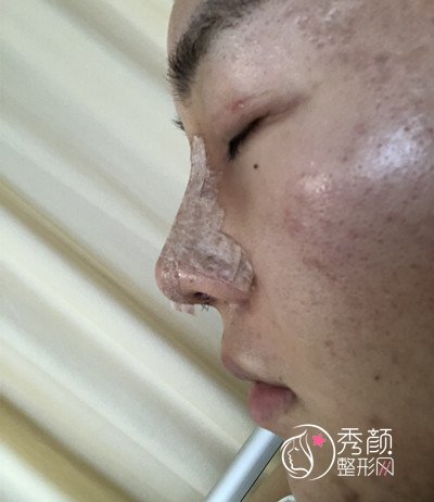 上海男士肋软骨隆鼻案例,恢复好了也是大帅哥一枚!