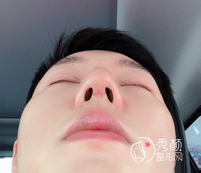 上海男士肋软骨隆鼻案例，恢复好了也是大帅哥一枚！