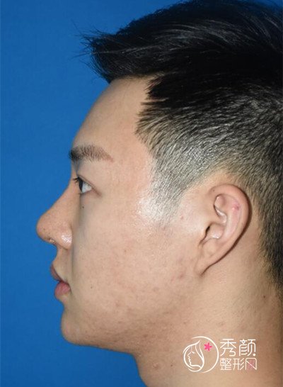 上海男士肋软骨隆鼻案例,恢复好了也是大帅哥一枚!