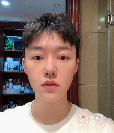 上海男士肋软骨隆鼻案例，恢复好了也是大帅哥一枚！