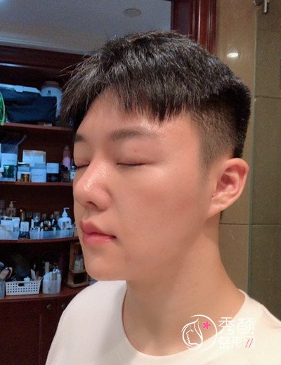 上海男士肋软骨隆鼻案例,恢复好了也是大帅哥一枚!
