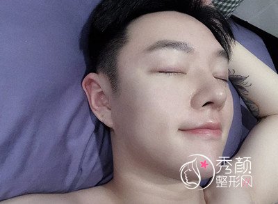 上海男士肋软骨隆鼻案例,恢复好了也是大帅哥一枚!