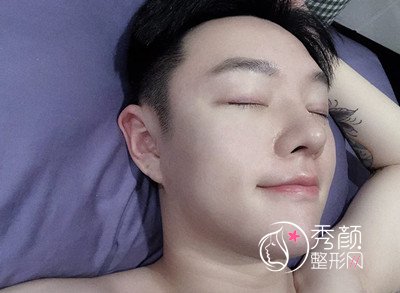 上海男士肋软骨隆鼻案例，恢复好了也是大帅哥一枚！