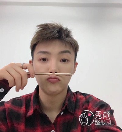 上海男士肋软骨隆鼻案例，恢复好了也是大帅哥一枚！