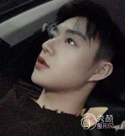 上海男士肋软骨隆鼻案例，恢复好了也是大帅哥一枚！