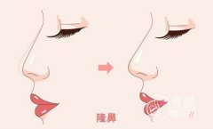 <b>什么是异体软骨隆鼻?有没有风险、后遗症?</b>