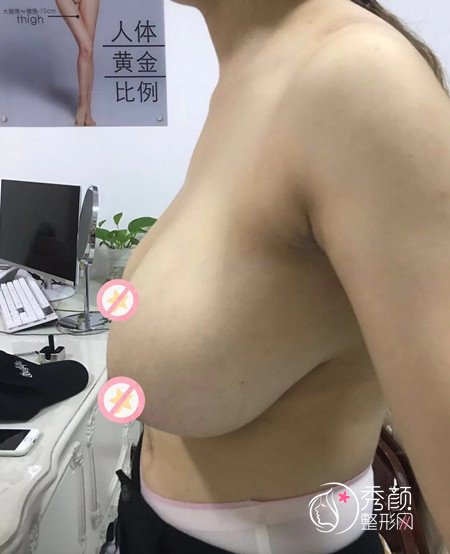 【巨乳缩小】缩胸手术案例分享。