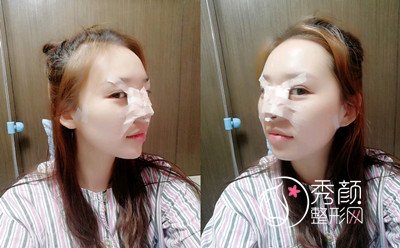 北京联合丽格师俊莉鼻部手术案例分享。