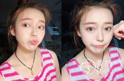 北京联合丽格师俊莉鼻部手术案例分享。