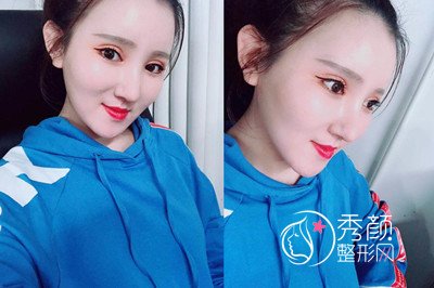 北京玲珑梵宫眼鼻部手术修复案例分享。