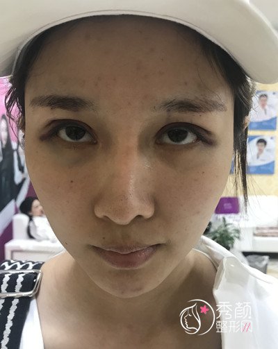 北京东方百合王世勇双眼皮修复案例分享。