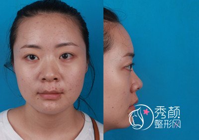 南京医科大学友谊整形外科医院肋软骨鼻部手术案
