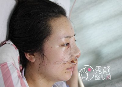 南京医科大学友谊整形外科医院肋软骨鼻部手术案