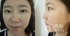 <b>王军鼻修复怎么样,王军做鼻子案例。</b>