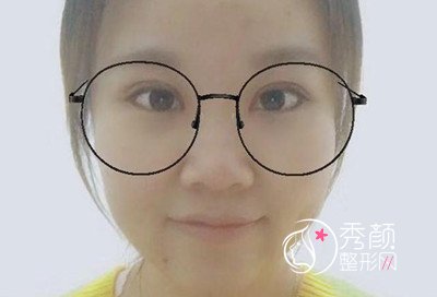 吴海龙做双眼皮怎么样,案例图。