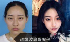 河南中医药大学第一附属医院磨骨怎么样,谁做的