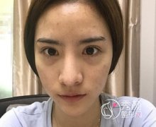 上海首尔丽格全脸脂肪填充怎么样,案例图。