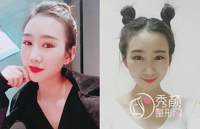 昆明韩辰(肋软骨+膨体)鼻部手术隆鼻案例。