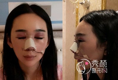 昆明韩辰(肋软骨+膨体)鼻部手术隆鼻案例。