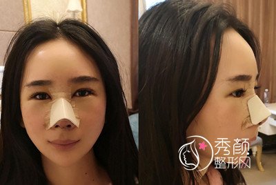 昆明韩辰(肋软骨+膨体)鼻部手术隆鼻案例。