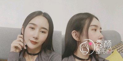 昆明韩辰(肋软骨+膨体)鼻部手术隆鼻案例。