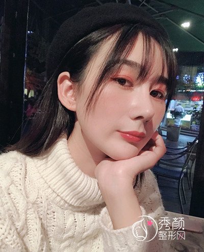 昆明韩辰(肋软骨+膨体)鼻部手术隆鼻案例。