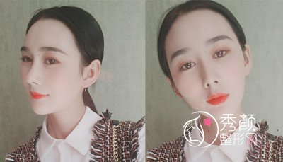 昆明韩辰(肋软骨+膨体)鼻部手术隆鼻案例。