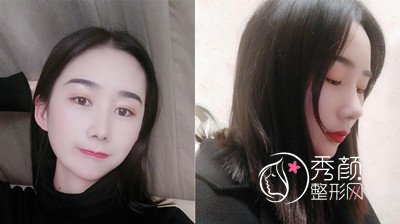 昆明韩辰(肋软骨+膨体)鼻部手术隆鼻案例。