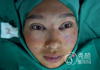 昆明韩辰眼部手术整形案例。