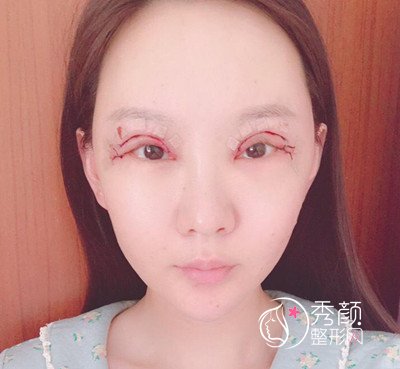 上海首尔丽格双眼皮修复（眼部手术）案例。