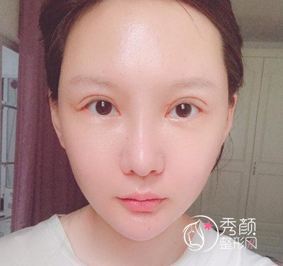 上海首尔丽格双眼皮修复(眼部手术)案例。