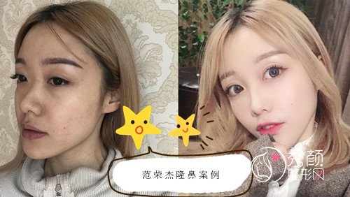 上海首尔丽格范荣杰隆鼻怎么样,多少钱啊?