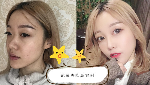 <b>上海首尔丽格范荣杰隆鼻怎么样,多少钱啊?</b>