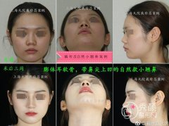 <b>上海九院戴传昌隆鼻怎么样,多少钱?</b>
