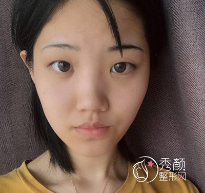 上海薇琳眼部手术做的怎么样,快来看案例分享。