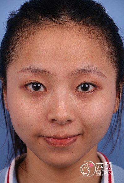 广州紫馨李政佑双眼皮修复技术怎样,案例分享。