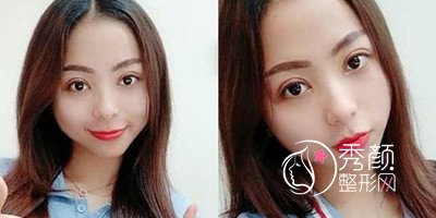 广州紫馨李政佑双眼皮修复技术怎样,案例分享。