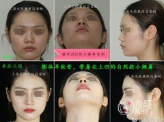 <b>戴传昌做鼻子怎么样，戴传昌做鼻子案例。</b>