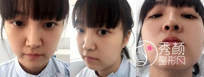 北京整形医生曾高隆鼻怎么样,真实案例分享。