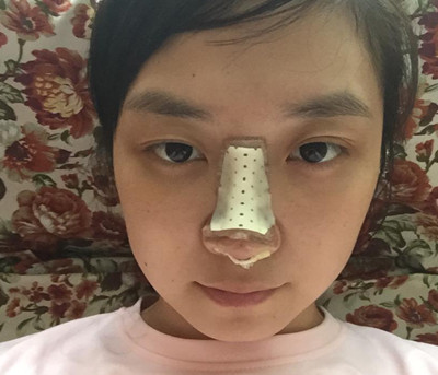 北京整形医生曾高隆鼻怎么样,真实案例分享。