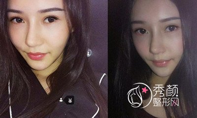 广州美莱罗延平鼻部手术怎么样,真实案例分享。