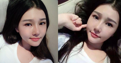 广州美莱罗延平鼻部手术怎么样,真实案例分享。