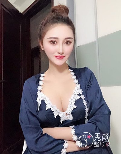 广州美莱李高峰隆胸怎么样,真实案例分享。