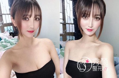 广州美莱李高峰隆胸怎么样,真实案例分享。